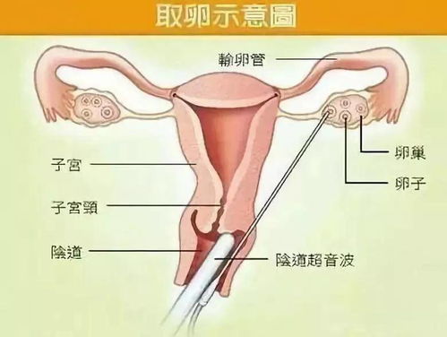 打工人新挑战，多囊卵巢综合症与生育的希望—如何将多囊不能怀孕转化为职业与生活的双赢